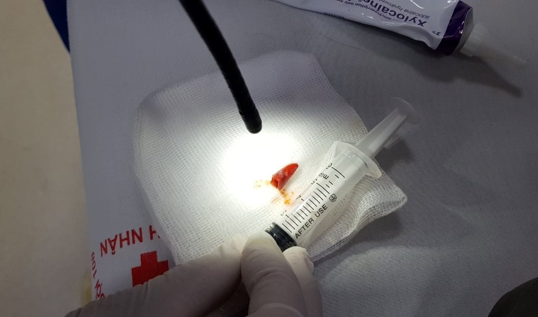 Ho khan nhiều ngày, bệnh nhân tá hỏa khi biết có miếng ớt trong phổi Hình ảnh kích thước mảnh ớt được lấy ra từ phế quản.