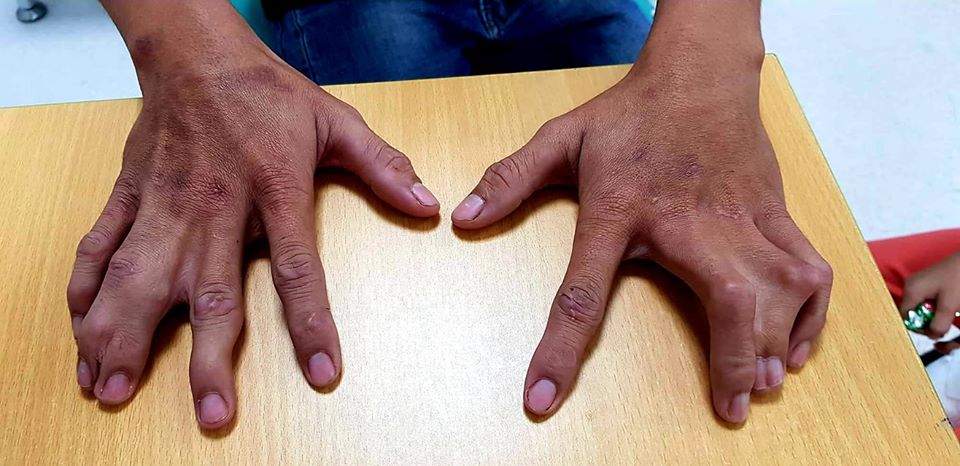 Một dòng họ 4 đời bị dị tật bàn tay càng tôm hùm Bàn tay của cha bé N. cũng bị dị tật càng tôm hùm