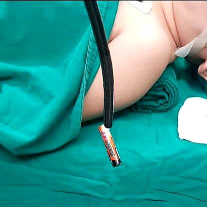 Bé gái 4 tuổi nhặt pin ở sàn nhà rồi nuốt luôn vào bụng Viên pin được nội soi xử lý cho bé A., ảnh BVCC