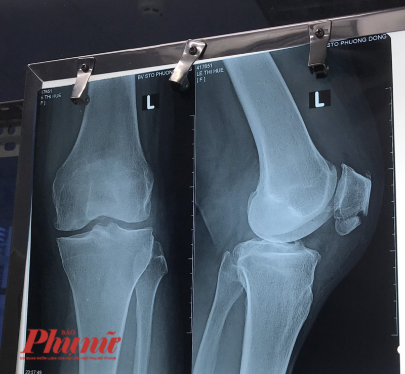 Bệnh nhân đột ngột tử vong khi điều trị gãy xương bánh chè Hình ảnh trên phim X-quang vết thương gãy xương bánh chè của bệnh nhân L.T.H., Long An