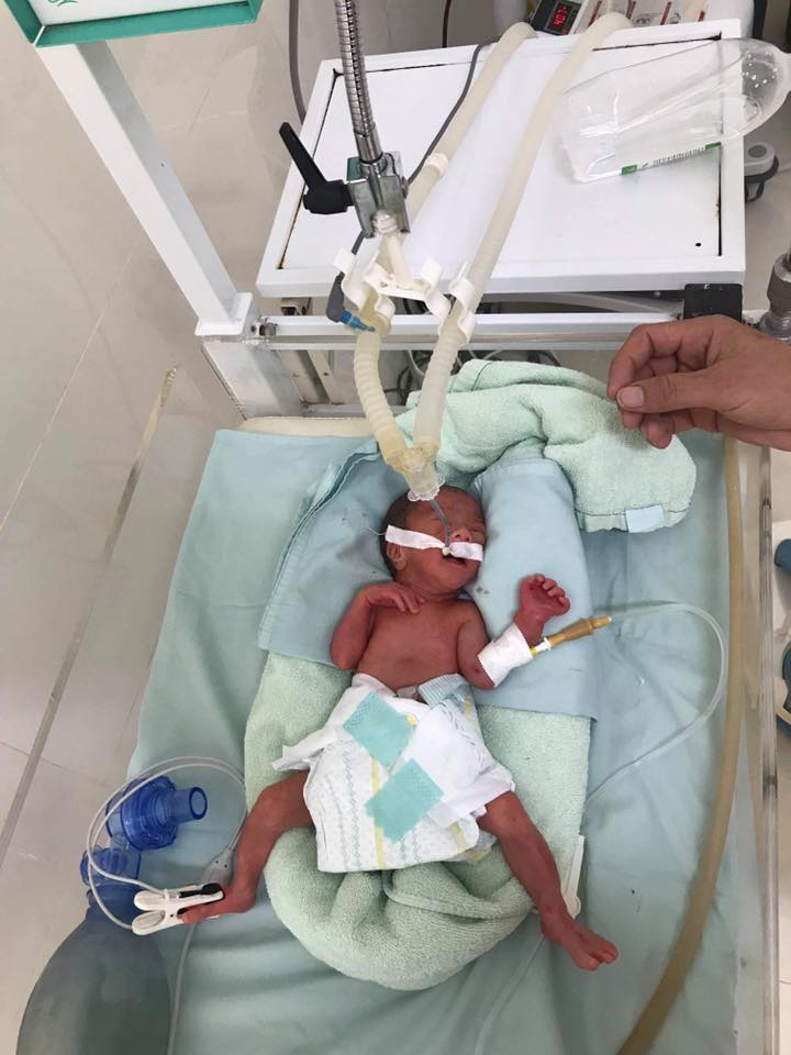 Hành trình đưa cháu bé chỉ nặng 800gram từ Hà Giang về Hà Nội tìm sự sống Em bé vừa mới sinh ở tuần 28 và chỉ nặng… 800 gr
