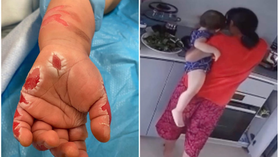 Người giúp việc cố tình nhúng tay bé gái 16 tháng tuổi vào nước sôi, gây bỏng độ 2 Cảnh quay từ camera cho thấy chính người giúp việc đã cho tay đứa trẻ vào nồi nước sôi.