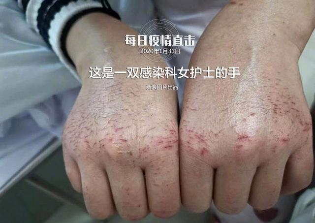 Bác sĩ Vũ Hán chạy đua với thời gian và những khoảnh khắc xúc động lòng người Đôi bàn tay nứt nẻ, sưng lên của một nữ y tá sau khi ngâm, khử trùng 84 lần để đảm bảo an toàn y tế khi chữa trị.