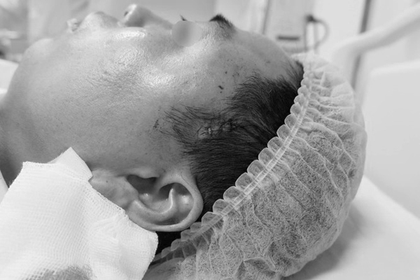 Độn thái dương làm đẹp, người đàn ông 33 tuổi chảy máu ồ ạt Bệnh nhân nhập viện khi thái dương trái liên tục chảy máu