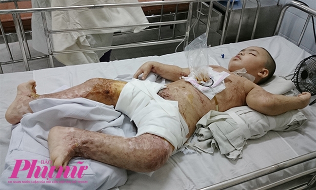 Hành trình nghị lực của cậu bé 5 tuổi bị phỏng nặng khi ngã vào chảo nước sôi Hanh trinh nghi luc cua cau be 5 tuoi bi phong nang khi nga vao chao nuoc soi