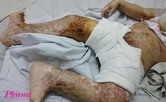 Hành trình nghị lực của cậu bé 5 tuổi bị phỏng nặng khi ngã vào chảo nước sôi Hanh trinh nghi luc cua cau be 5 tuoi bi phong nang khi nga vao chao nuoc soi