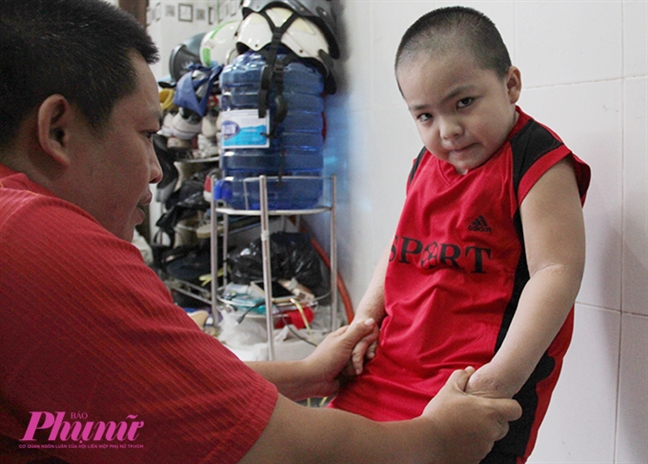 Hành trình nghị lực của cậu bé 5 tuổi bị phỏng nặng khi ngã vào chảo nước sôi Hanh trinh nghi luc cua cau be 5 tuoi bi phong nang khi nga vao chao nuoc soi