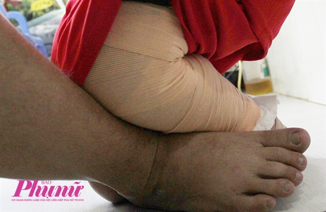 Hành trình nghị lực của cậu bé 5 tuổi bị phỏng nặng khi ngã vào chảo nước sôi Hanh