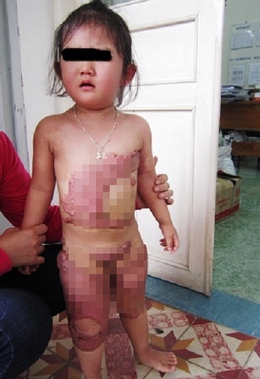 Ám ảnh những vết sẹo bỏng in hằn trên cơ thể trẻ thơ Am anh nhung vet seo bong in han tren co the tre tho