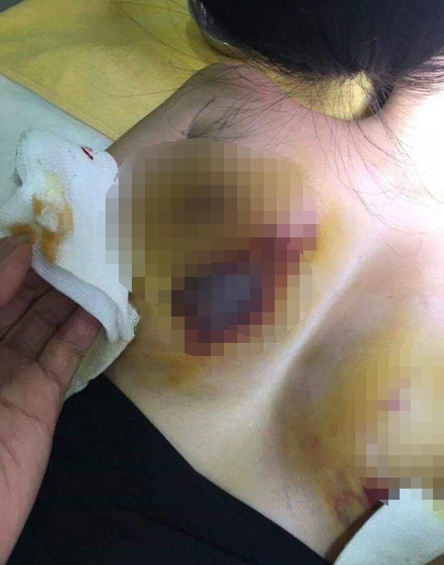 Bộ Y tế yêu cầu làm rõ vụ bệnh nhân tố bệnh viện phẫu thuật thẩm mỹ gây biến chứng Bo Y te yeu cau lam ro vu benh nhan to benh vien phau thuat tham my gay bien chung
