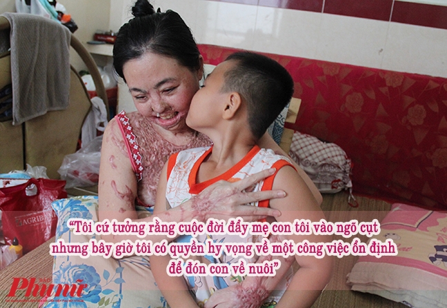 Bệnh viện Quận 2 nhận mổ miễn phí cho 'người mẹ ma' do axit Benh vien Quan 2 nhan mo mien phi cho 'nguoi me ma' do axit