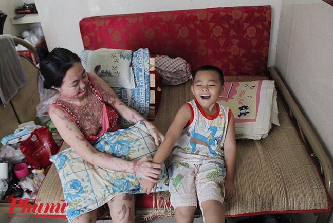 Bệnh viện Quận 2 nhận mổ miễn phí cho 'người mẹ ma' do axit Benh vien Quan 2 nhan mo mien phi cho 'nguoi me ma' do axit
