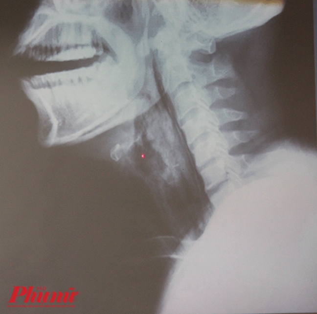 Tưởng mắc xương cá, không ngờ dính phải căn bệnh chết người Tuong mac xuong ca, khong ngo dinh phai can benh chet nguoi