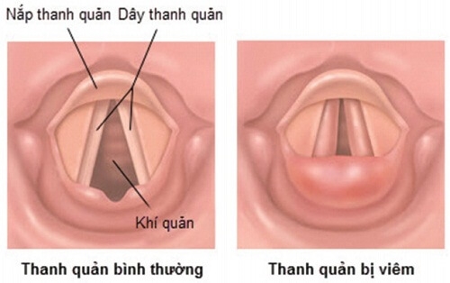Tưởng mắc xương cá, không ngờ dính phải căn bệnh chết người Tuong mac xuong ca, khong ngo dinh phai can benh chet nguoi