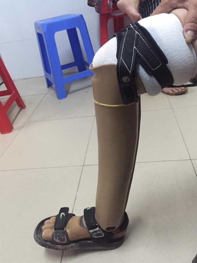 Đã dùng chân giả vẫn bị chân ma... 'hiện về' hành đau nhức Da dung chan gia van bi chan ma... 'hien ve' hanh dau nhuc