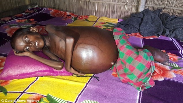 Đau lòng cậu bé 7 tuổi mang bụng to hơn trái banh Dau long cau be 7 tuoi mang bung to hon trai banh