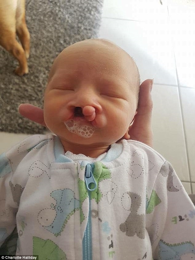 Chùm ảnh nụ cười đầu tiên của em bé sứt môi thu hút hàng nghìn người xem Chum anh nu cuoi dau tien cua em be sut moi thu hut hang nghin nguoi xem