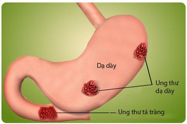 Nghĩ ốm nghén, thai phụ không ngờ ung thư giai đoạn cuối Nghi om nghen, thai phu khong ngo ung thu giai doan cuoi