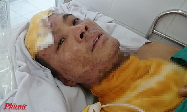Còn vài tháng ra trường, nam sinh viên ham học bị điện giật cháy sâu vào xương sọ Con vai thang ra truong, nam sinh vien ham hoc bi dien giat chay sau vao xuong so