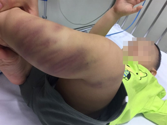 Khởi tố điều tra vụ cháu bé 1 tuổi nghi bị bạo hành ở Hà Nội Khoi to dieu tra vu chau be 1 tuoi nghi bi bao hanh o Ha Noi