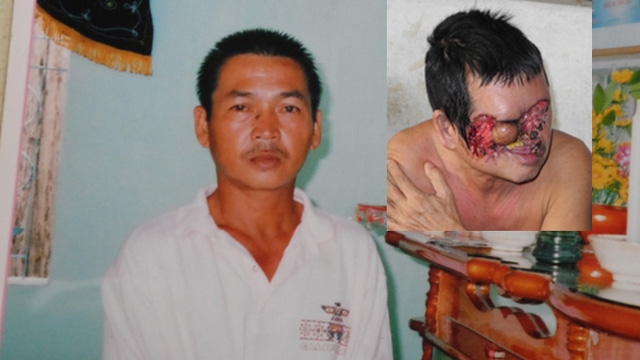 Bi hài chuyện thẩm mỹ nốt ruồi theo tướng số để gặp may Bi hai chuyen tham my not ruoi theo tuong so de gap may