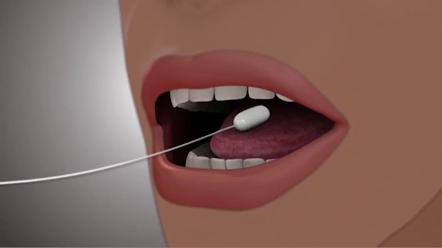 5 người tử vong khi chèn bong bóng dạ dày giảm cân 5 nguoi tu vong khi chen bong bong da day giam can