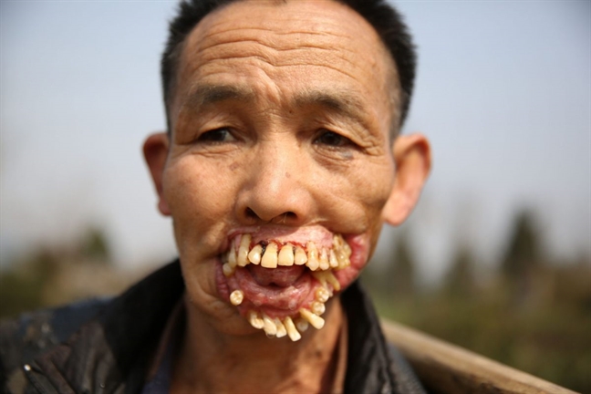 Những hàm răng kinh dị nhất thế giới Nhung ham rang kinh di nhat the gioi