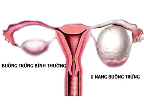 U nang buồng trứng có nguy hiểm không? U nang buong trung co nguy hiem khong?