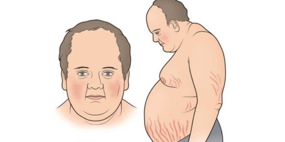 Tưởng béo phì, hóa ra mắc bệnh cực hiếm Tuong beo phi, hoa ra mac benh cuc hiem