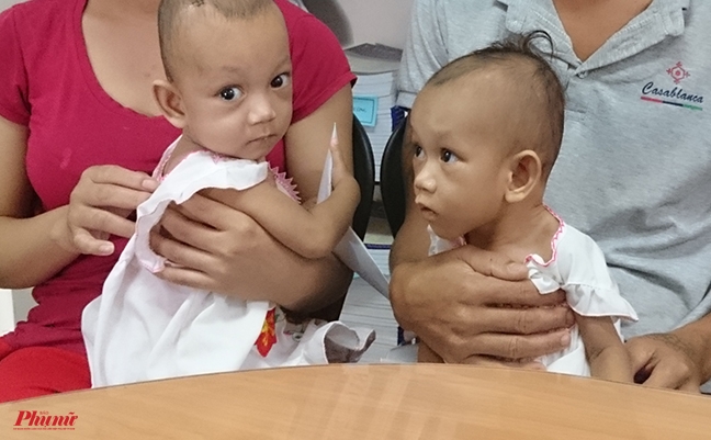 Ông bố người S'tiêng vui mừng ôm con gái sinh đôi được tách rời phần mông Ong bo nguoi S'tieng vui mung om con gai sinh doi duoc tach roi phan mong