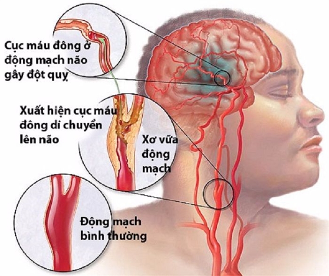 Hư nửa bộ não vì... quá chén Hu nua bo nao vi... qua chen