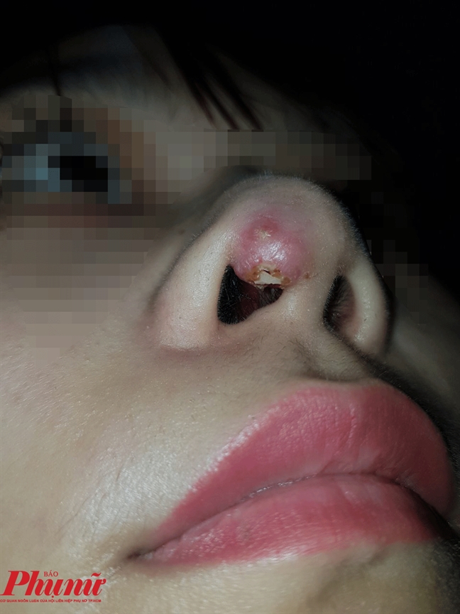Xóa nốt ruồi, thu lỗ mũi vì... sợ tiền ra Xoa not ruoi, thu lo mui vi... so tien ra