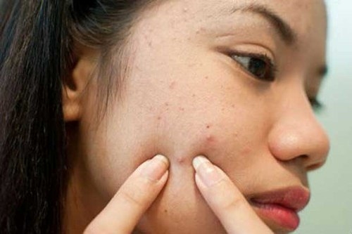Quy trình tuần 3 lần xông hơi sả, chanh, gừng trị mụn, trắng da Quy trinh tuan 3 lan xong hoi sa, chanh, gung tri mun, trang da