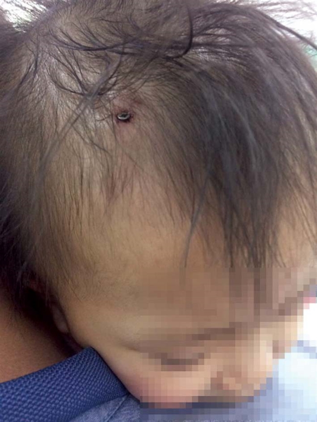 Những tai nạn thường gặp ở trẻ Nhung tai nan thuong gap o tre