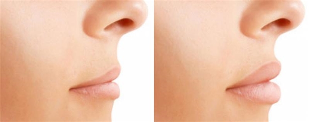 Lời khuyên từ cô gái 25 tuổi trải nghiệm phẫu thuật làm đầy môi Loi khuyen tu co gai 25 tuoi trai nghiem phau thuat lam day moi