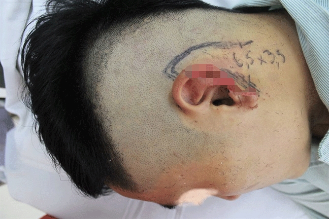 Nam thanh niên Hà Nội đi nhậu với bạn bị cắn đứt tai Nam thanh nien Ha Noi di nhau voi ban bi can dut tai
