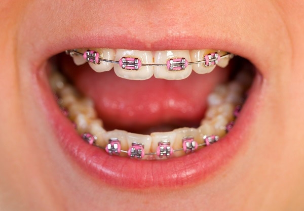 Cần cân nhắc kỹ trước khi niềng răng cho trẻ Can can nhac ky truoc khi nieng rang cho tre
