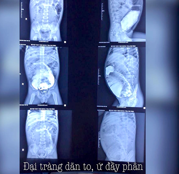 Bé trai 5 tuổi bị táo bón 5 năm Be trai 5 tuoi bi tao bon 5 nam