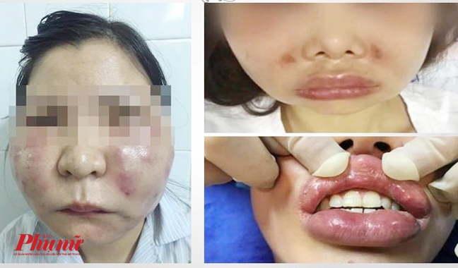 Vì sao mắt mù sau khi tiêm filler vào mũi? Vi sao mat mu sau khi tiem filler vao mui?
