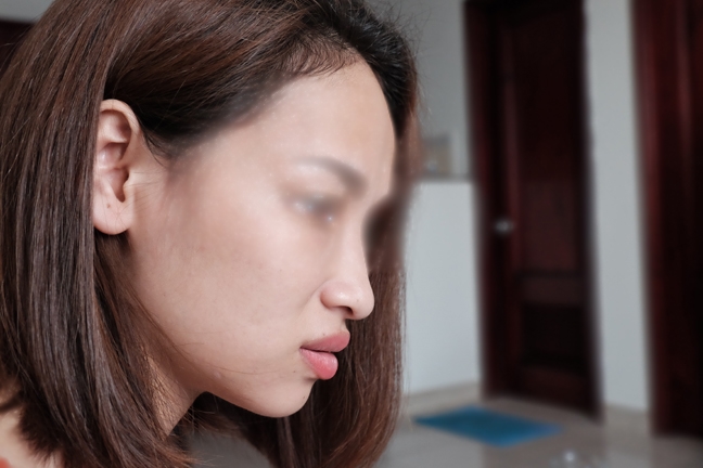 Vì sao mắt mù sau khi tiêm filler vào mũi? Vi sao mat mu sau khi tiem filler vao mui?