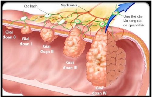 Cách phát hiện ung thư phổi sớm Cach phat hien ung thu phoi som
