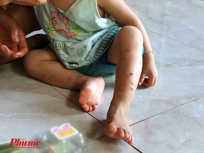Vi rút HIV có lây qua đường gãi ghẻ? Vi rut HIV co lay qua duong gai ghe?