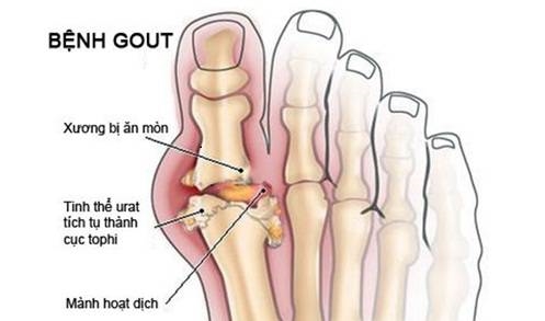 Không tin mình mắc bệnh gout, người phụ nữ tự uống thuốc đến nôn ra máu Khong tin minh mac benh gout, nguoi phu nu tu uong thuoc den non ra mau