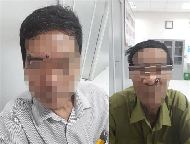 Cậy nốt ruồi vướng víu, mới biết mình mắc bệnh ung thư Cay not ruoi vuong viu, moi biet minh mac benh ung thu