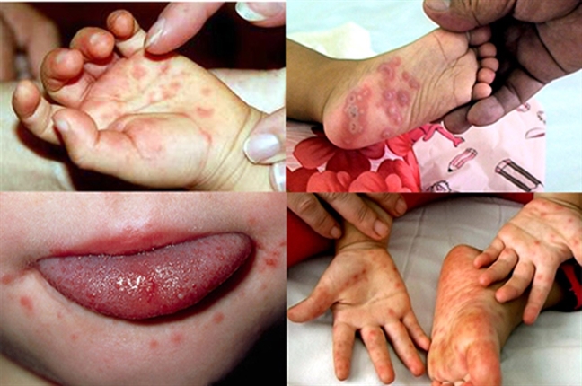 Cách chăm sóc trẻ bị tay chân miệng tại nhà Cach cham soc tre bi tay chan mieng tai nha