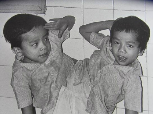 30 năm mổ tách cặp song sinh Việt - Đức: Niềm vui như mới ngày hôm qua 30 nam mo tach cap song sinh Viet - Duc: Niem vui nhu moi ngay hom qua