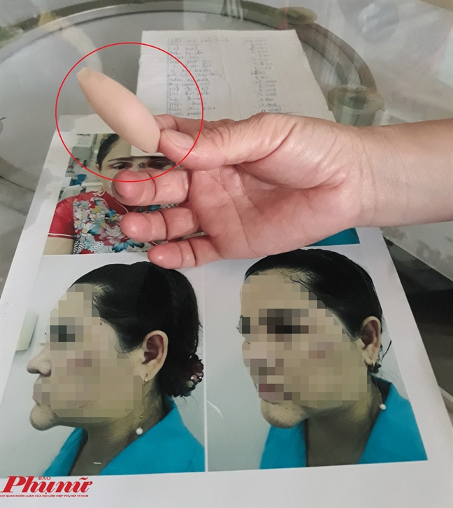 Khách hàng tố gây biến chứng, thanh tra đình chỉ hoạt động nhưng thẩm mỹ viện vẫn tiếp tục 'dụ' khách Khach hang to gay bien chung, thanh tra dinh chi hoat dong nhung tham my vien van tiep tuc 'du' khach