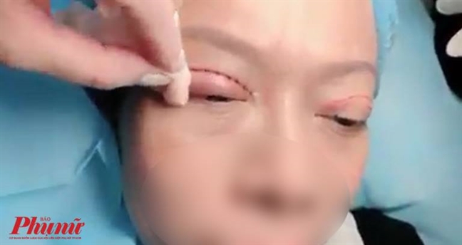 Nhân viên thẩm mỹ viện bị biến chứng do đưa mặt cho chủ tiệm ‘đập đi xây lại’ Nhan vien tham my vien bi bien chung do dua mat cho chu tiem ‘dap di xay lai’