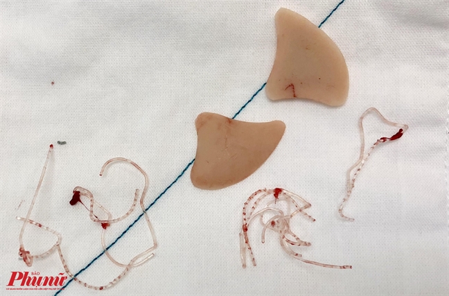 Nhân viên thẩm mỹ viện bị biến chứng do đưa mặt cho chủ tiệm ‘đập đi xây lại’ Nhan vien tham my vien bi bien chung do dua mat cho chu tiem ‘dap di xay lai’