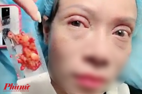 Nhân viên thẩm mỹ viện bị biến chứng do đưa mặt cho chủ tiệm ‘đập đi xây lại’ Nhan vien tham my vien bi bien chung do dua mat cho chu tiem ‘dap di xay lai’
